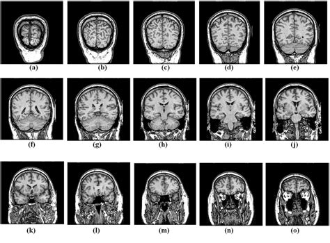 mri slice thickness test|slice thickness brain metastatic lesions.